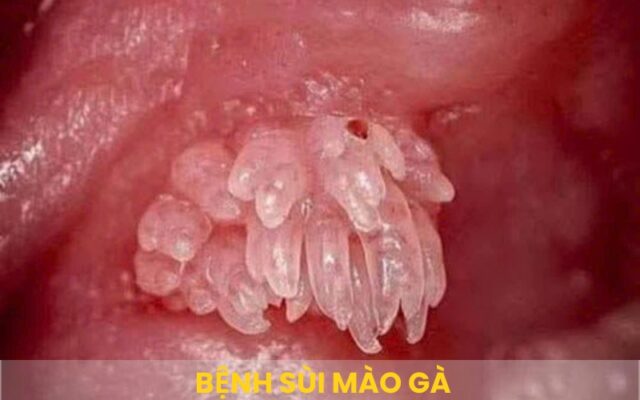 Banner benh sui mao ga 001