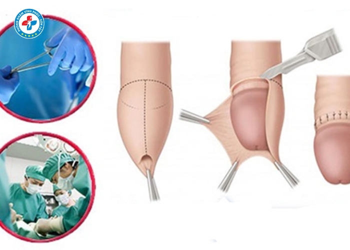 Cắt Bao Quy Đầu Tại Vĩnh Phúc (10)