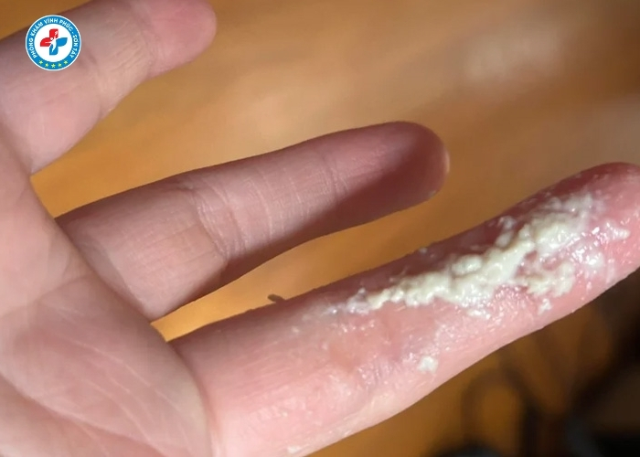 Chữa khí hư bất thường tại Sơn Tây (4)