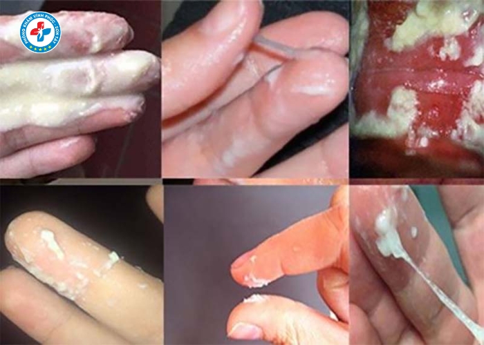 Chữa khí hư bất thường tại Vĩnh Tường (2)