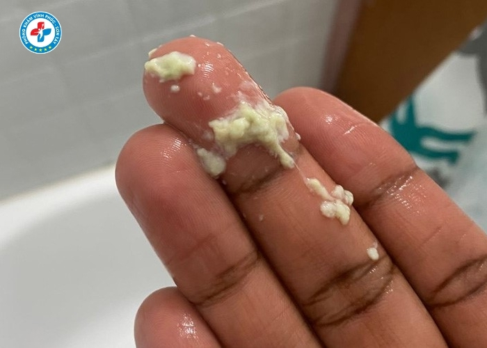 Chữa khí hư bất thường tại Vĩnh Tường (4)