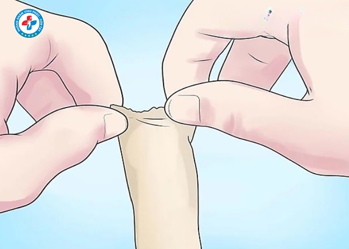 Điều Trị Dài Bao Quy Đầu Tại Vĩnh Phúc (4)