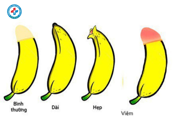 Điều Trị Dài Bao Quy Đầu Tại Vĩnh Phúc (5)