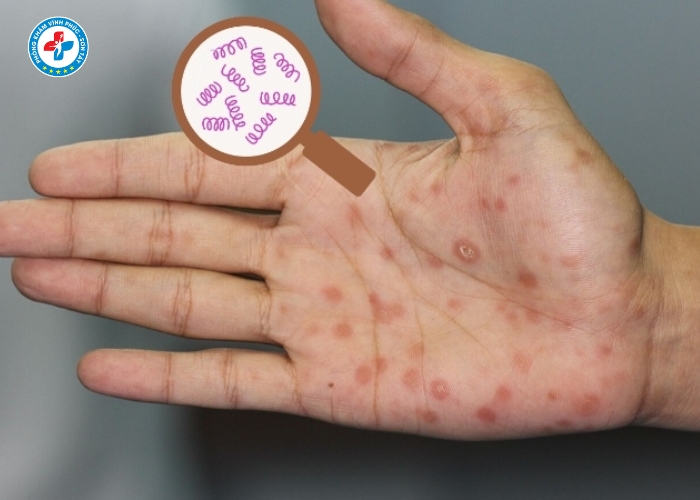 Điều Trị Giang Mai Nam Tại Vĩnh Tường (6)