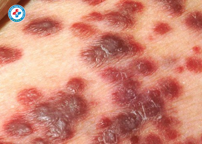 Điều Trị Giang Mai Nam Tại Vĩnh Tường (7)