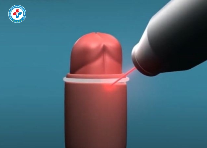 Điều Trị Hẹp Bao Quy Đầu Tại Vĩnh Phúc (9)