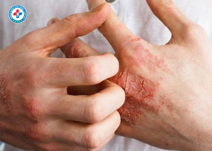 Điều Trị Lậu Nam Tại Vĩnh Tường (8)