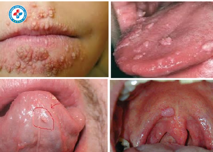 Điều Trị Sùi Mào Gà Nam Tại Vĩnh Tường (2)