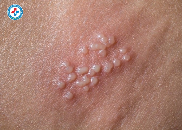 Điều Trị Sùi Mào Gà Nam Tại Vĩnh Tường (4)