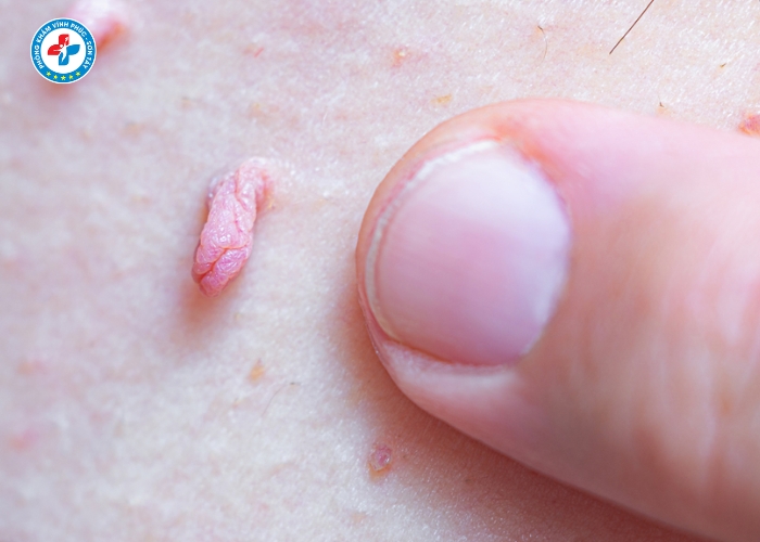 Điều Trị Sùi Mào Gà Nam Tại Vĩnh Tường (5)