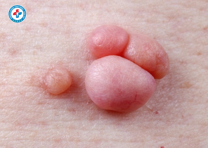 Điều Trị Sùi Mào Gà Nam Tại Vĩnh Tường (8)