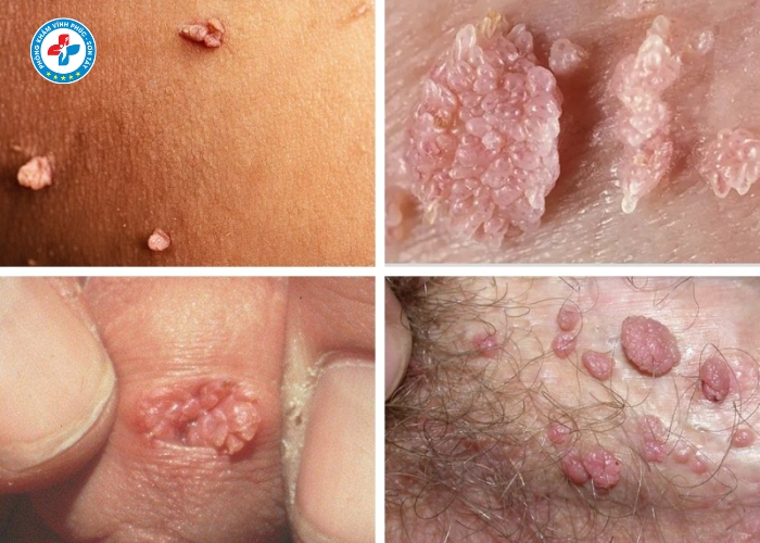 Điều Trị Sùi Mào Gà Nam Tại Vĩnh Tường (9)