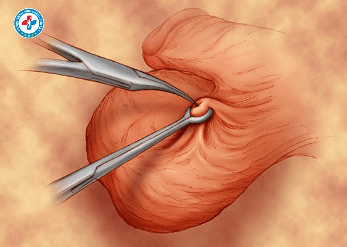 Phẩu thuật thắt ống dẫn tinh tại Vĩnh Tường (3)