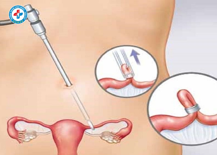 Phẩu thuật thắt ống dẫn tinh tại Vĩnh Tường (4)