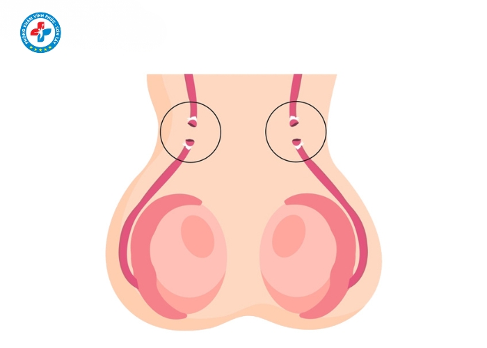 Phẩu thuật thắt ống dẫn tinh tại vĩnh phúc (6)