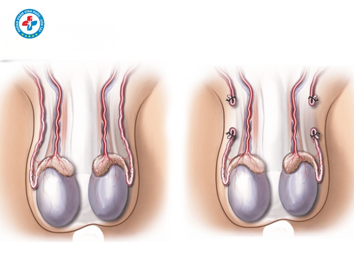 Thắt Ống Dẫn Tinh Tại Vĩnh Tường (3)