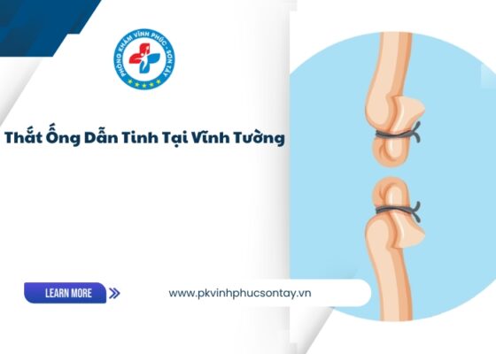 Thắt Ống Dẫn Tinh Tại Vĩnh Tường (6)