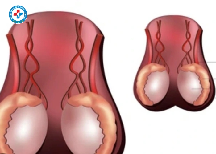 Thắt ống dẫn tinh tại Vĩnh Phúc (8)