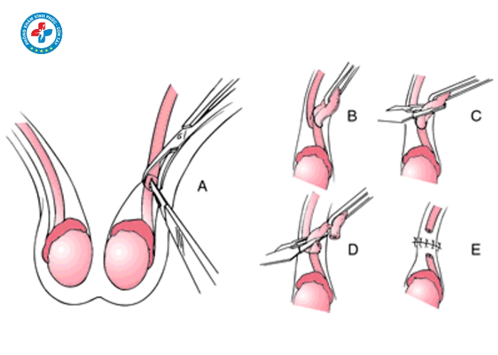Thắt ống dẫn tinh tại Vĩnh Phúc (9)