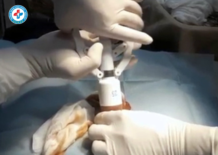 cắt bao quy đầu tại Vĩnh Tường (5)