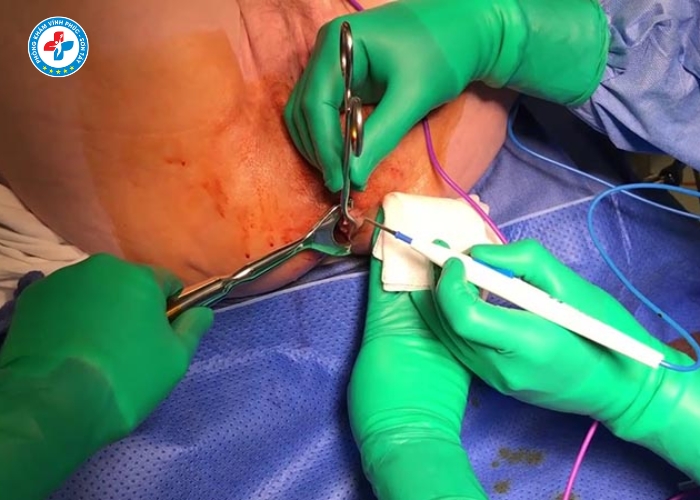 cắt trĩ không đau tại Sơn Tây (2)