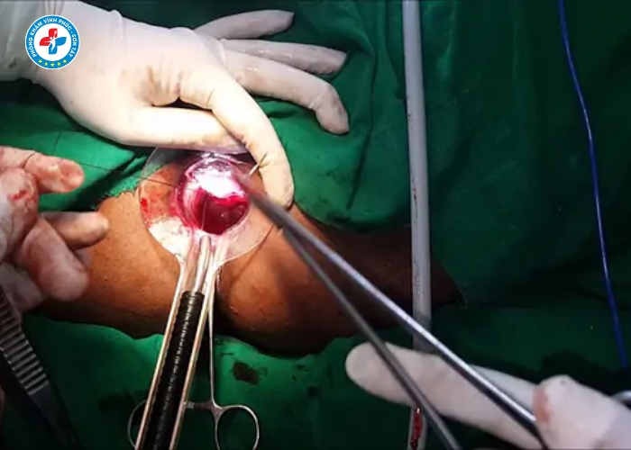 cắt trĩ không đau tại Sơn Tây (3)