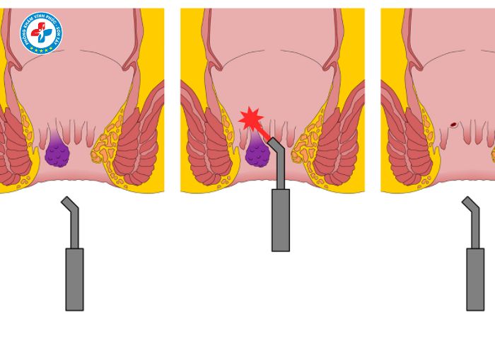 cắt trĩ không đau tại Vĩnh Tường (1)