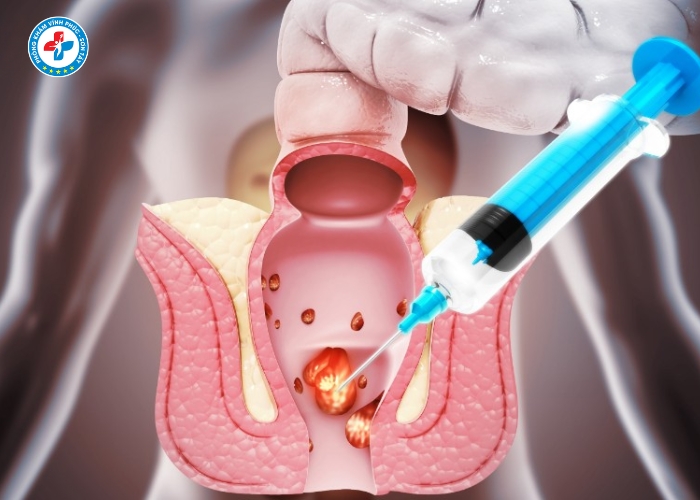 cắt trĩ không đau tại Vĩnh Tường (8)