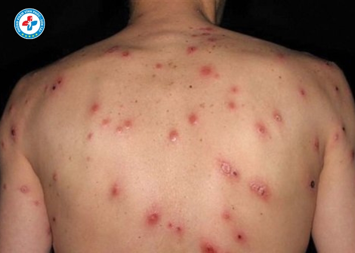 điều trị giang mai nam tại Vĩnh Phúc (1)