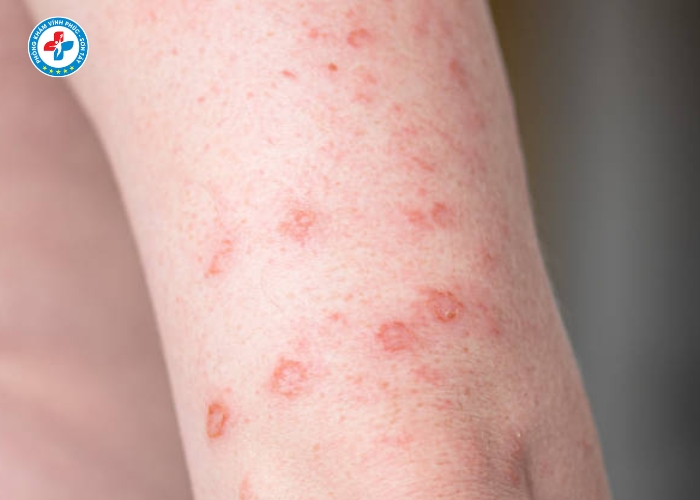 điều trị giang mai nam tại Vĩnh Phúc (2)