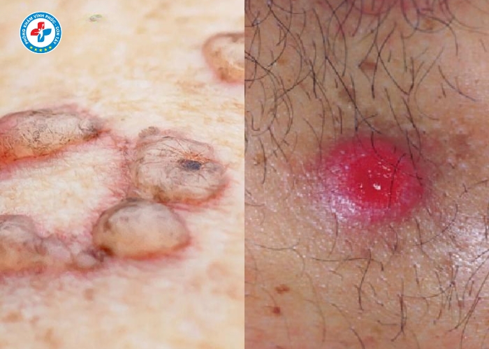 điều trị giang mai nam tại Vĩnh Phúc (4)