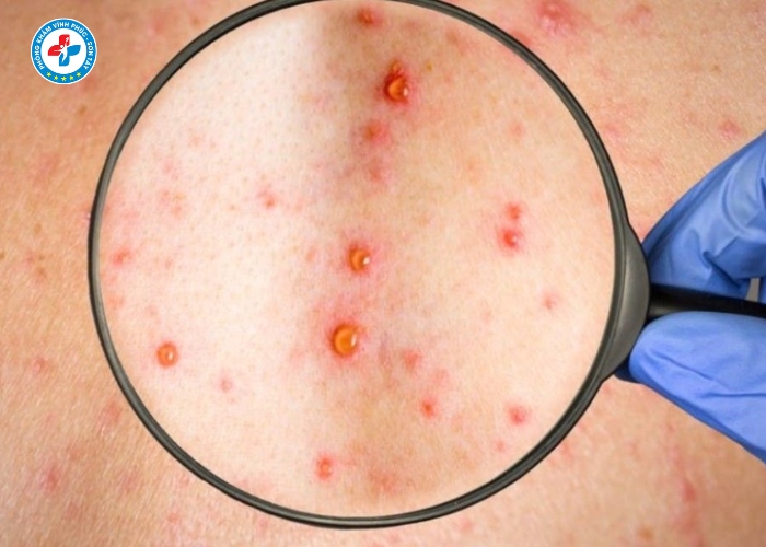 điều trị giang mai nam tại Vĩnh Phúc (5)