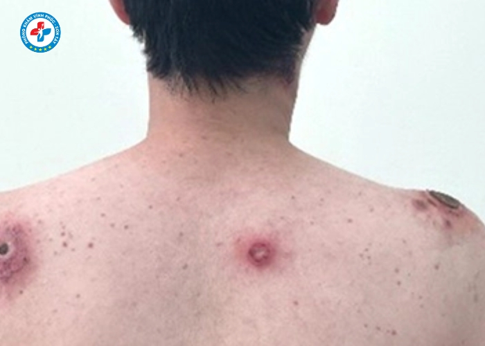 điều trị giang mai nam tại Vĩnh Phúc (9)