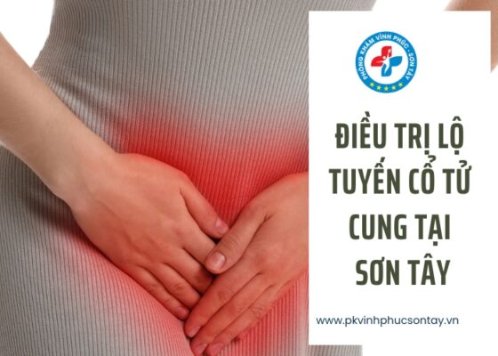 điều trị lộ tuyến cổ tử cung tại Sơn Tây