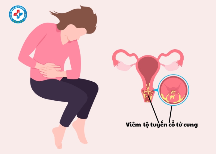 điều trị lộ tuyến cổ tử cung tại Vĩnh Phúc (1)