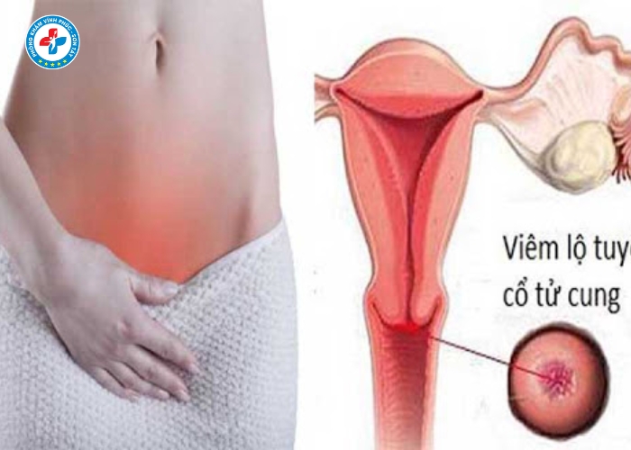 điều trị lộ tuyến cổ tử cung tại Vĩnh Phúc (6)