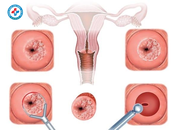 điều trị lộ tuyến cổ tử cung tại Vĩnh Tường (2)