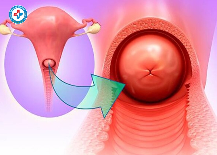 điều trị lộ tuyến cổ tử cung tại Vĩnh Tường (3)