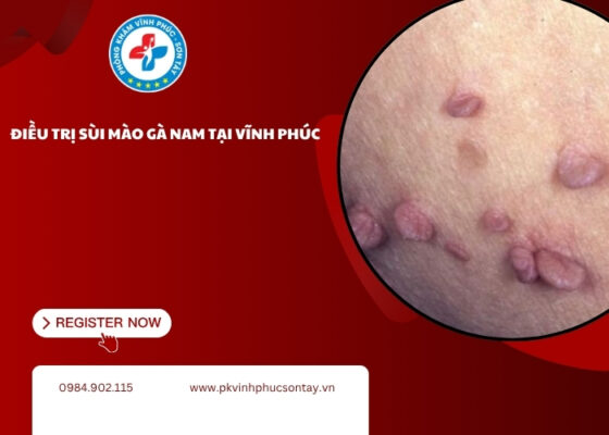 điều trị sùi mào gà nam tại Vĩnh Phúc