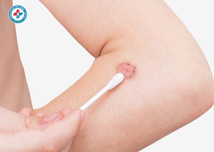 điều trị sùi mào gà nam tại Vĩnh Phúc (6)