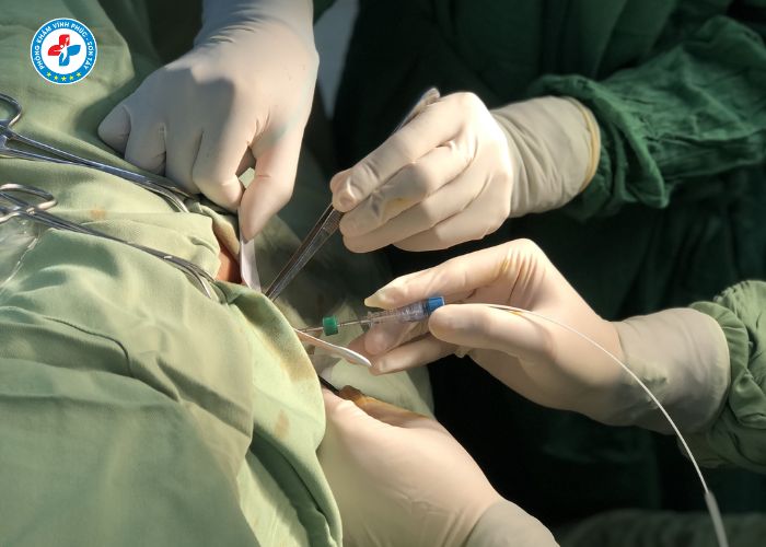 điều trị trĩ công nghệ cao tại Vĩnh Tường (2)