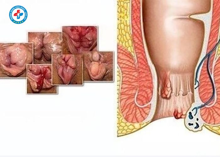 điều trị trĩ trọn gói tại Vĩnh Phúc (10)