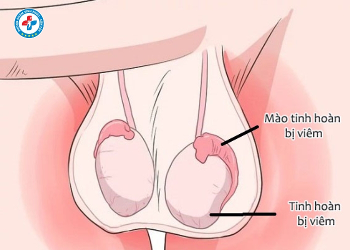 điều trị viêm mào tinh tại Vĩnh Tường (6)