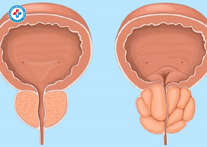 điều trị viêm tuyến tiền liệt tại Vĩnh Phúc (6)
