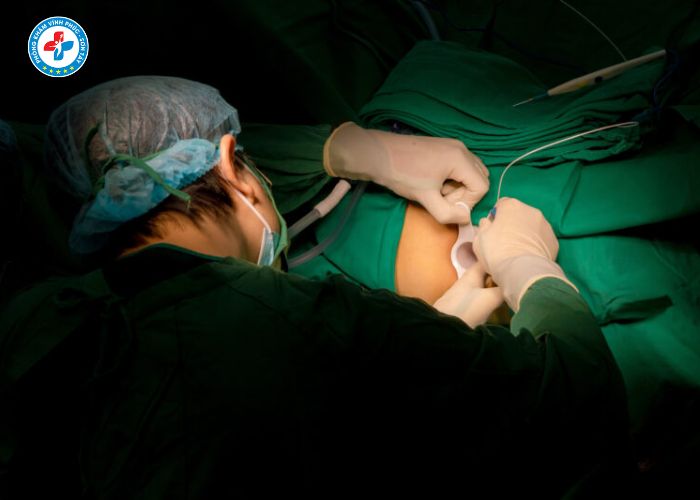 đốt trĩ laser tại Vĩnh Phúc (17)