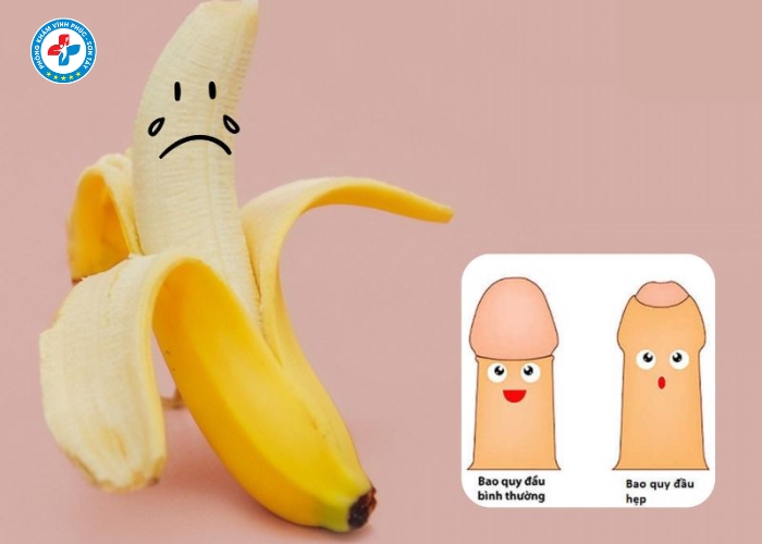 hẹp bao quy đầu tại Vĩnh Tường (1)