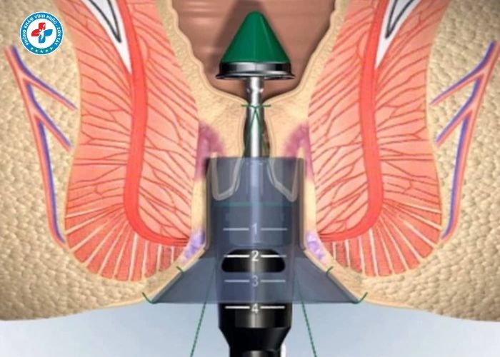 phẫu thuật trĩ tại Vĩnh Phúc (3)