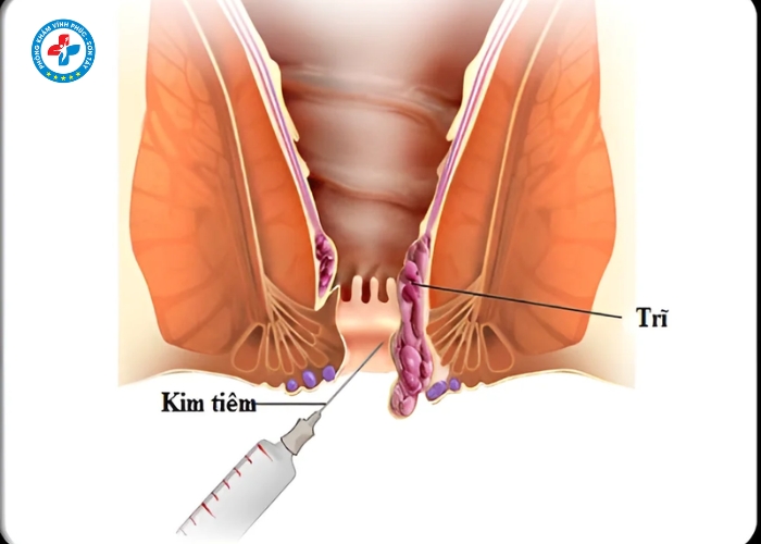 tiêm tiêu búi trĩ tại Sơn Tây (4)