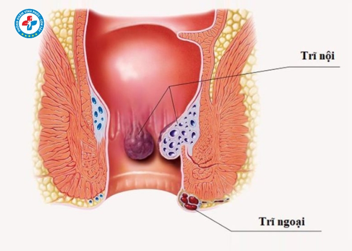 tiêm tiêu búi trĩ tại Sơn Tây (5)