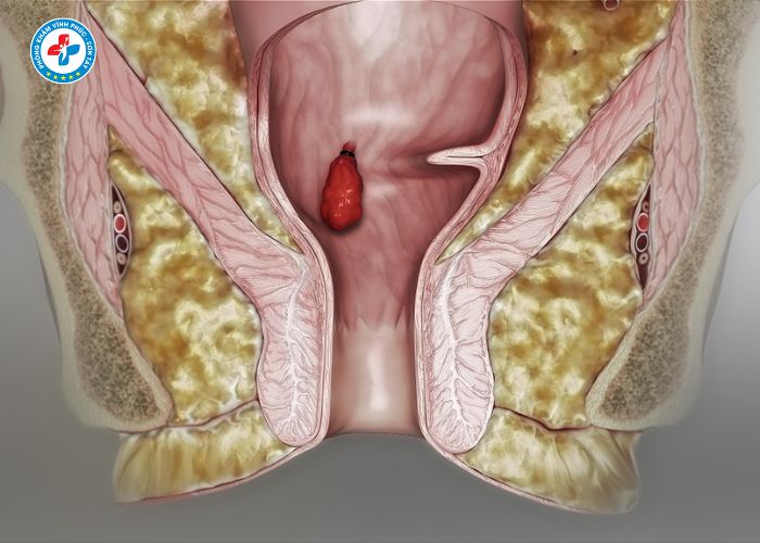 tiêm tiêu búi trĩ tại Vĩnh Phúc (2)